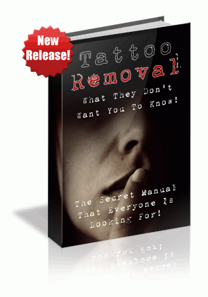 Tattoo Removal