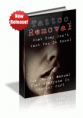 Tattoo Removal